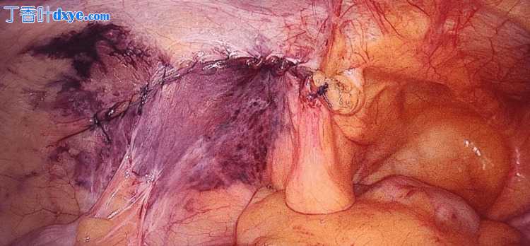 腹腔镜经腹腹膜前 (TAPP) 修复的早期结果