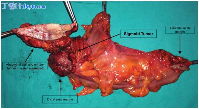 腹腔镜与开腹结肠癌切除术在中等体积中心的肿瘤切除质量评估