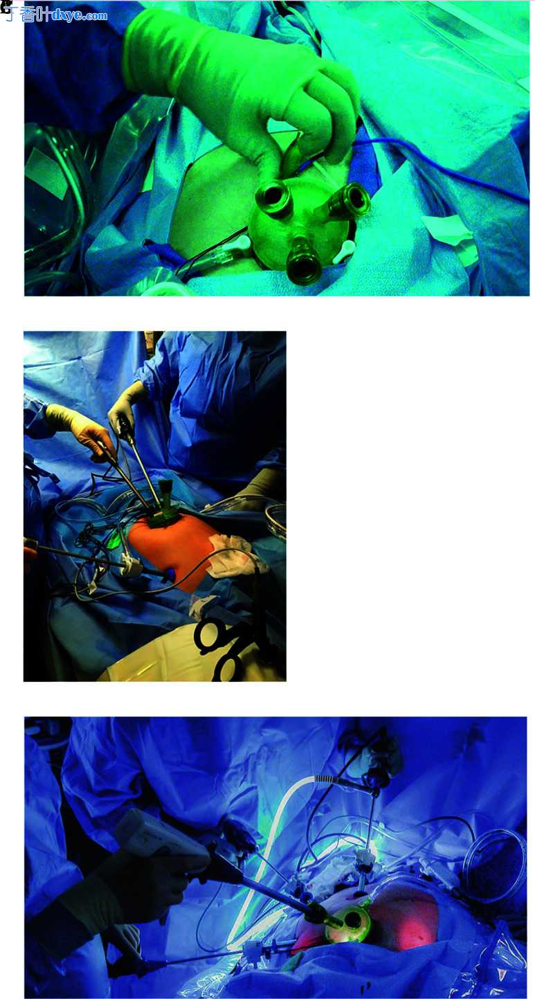 阴道自然孔道腔内镜手术革命：妇科微创手术的下一个前沿