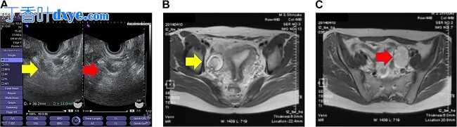 单孔腹腔镜手术治疗大网膜寄生性囊性畸胎瘤及双侧卵巢畸胎瘤一例