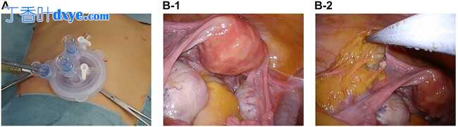 单孔腹腔镜手术治疗大网膜寄生性囊性畸胎瘤及双侧卵巢畸胎瘤一例