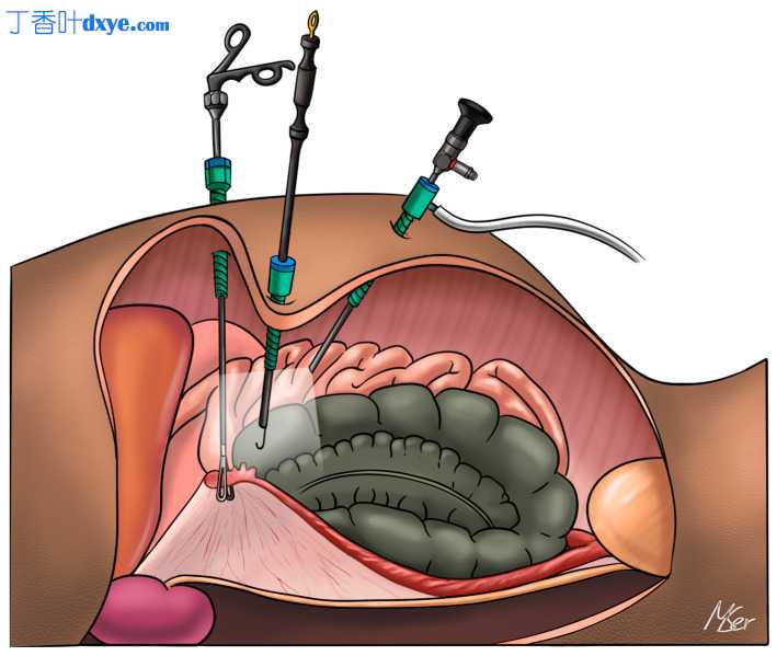 腹腔镜输卵管切除术和输精管切除术抑制自由放养海狸鼠 (Myocastor coypus) 的生育能力
