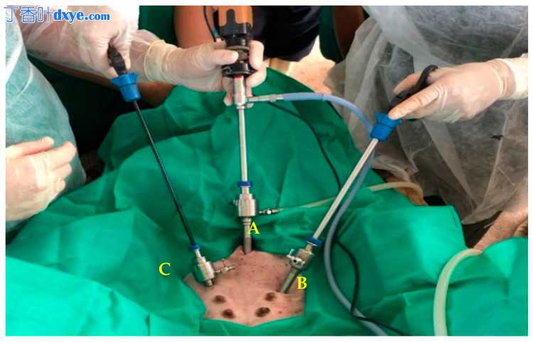 水牛犊腹腔镜取卵术的手术描述