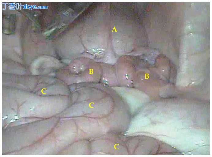 水牛犊腹腔镜取卵术的手术描述