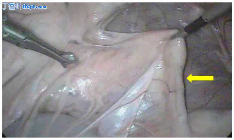 水牛犊腹腔镜取卵术的手术描述