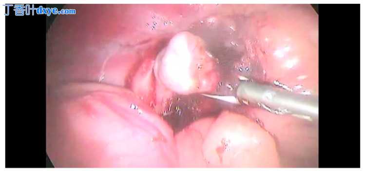 犬双孔腹腔镜肾上腺切除术