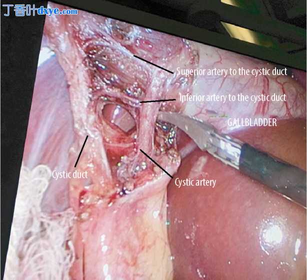 动脉与胆囊管的重复：一例具有外科意义的罕见解剖变异的病例报告