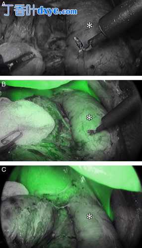 术中吲哚菁绿 (ICG) 和术前 3 维 (3D) 重建在腹腔镜肾上腺切除术中的作用：倾向评...