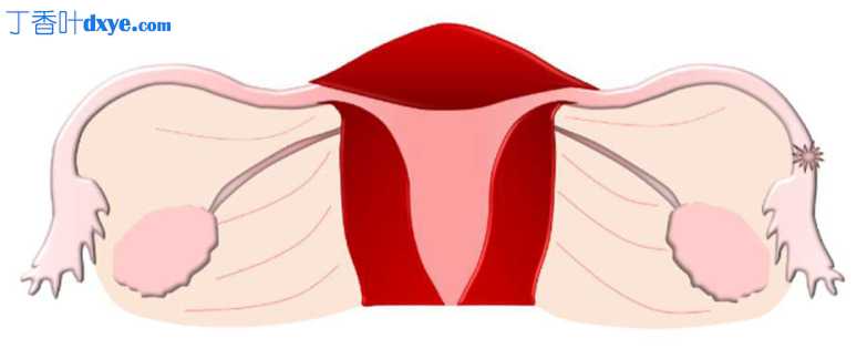 输卵管解剖变异和先天性异常及其对生育能力的影响概述