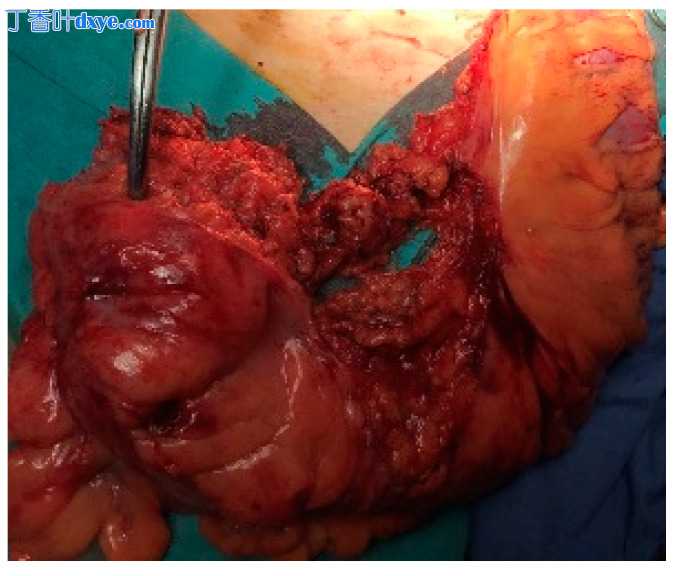 腹腔镜 Hartmann 手术——一种仍然可以挽救生命的手术