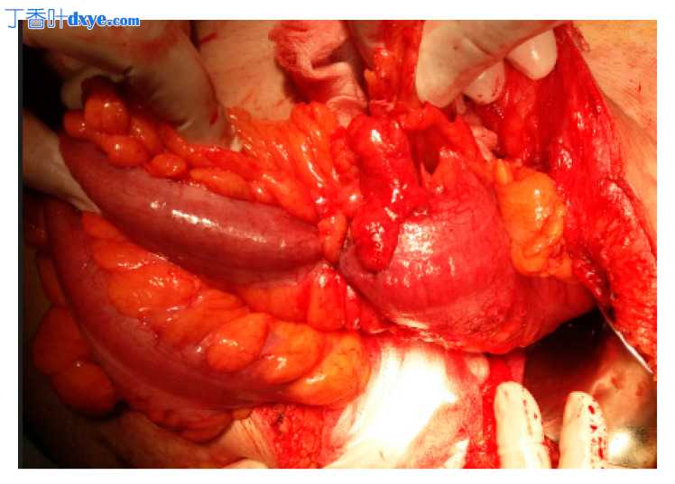 腹腔镜 Hartmann 手术——一种仍然可以挽救生命的手术