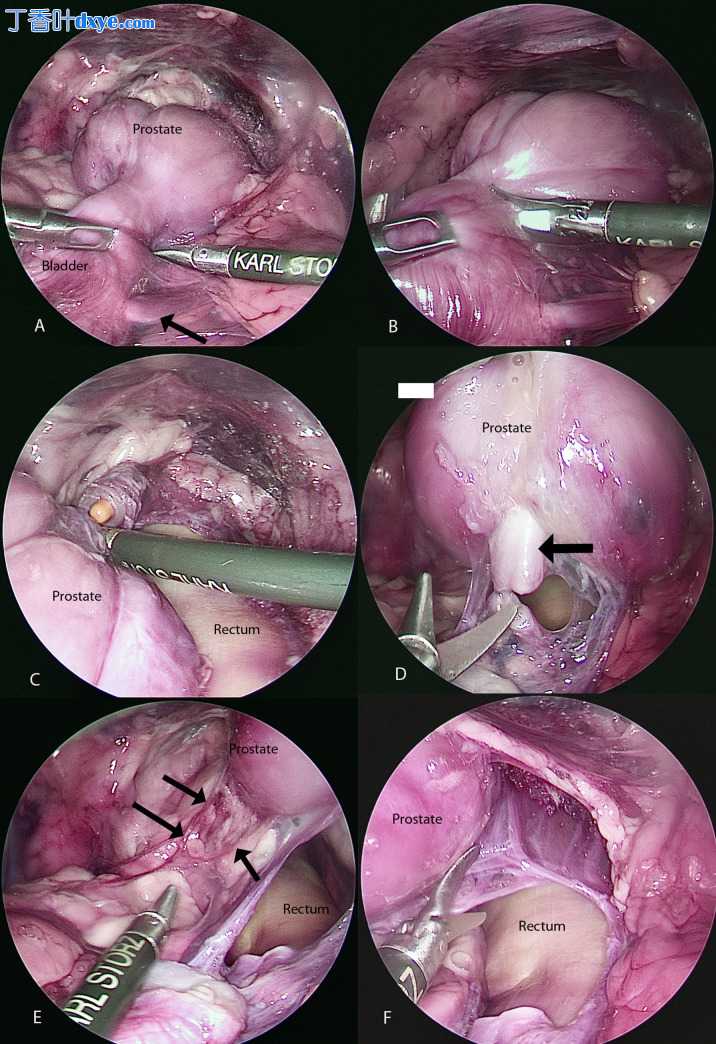 犬尸体腹腔镜根治性前列腺切除术技术描述：2D 与 3D 相机