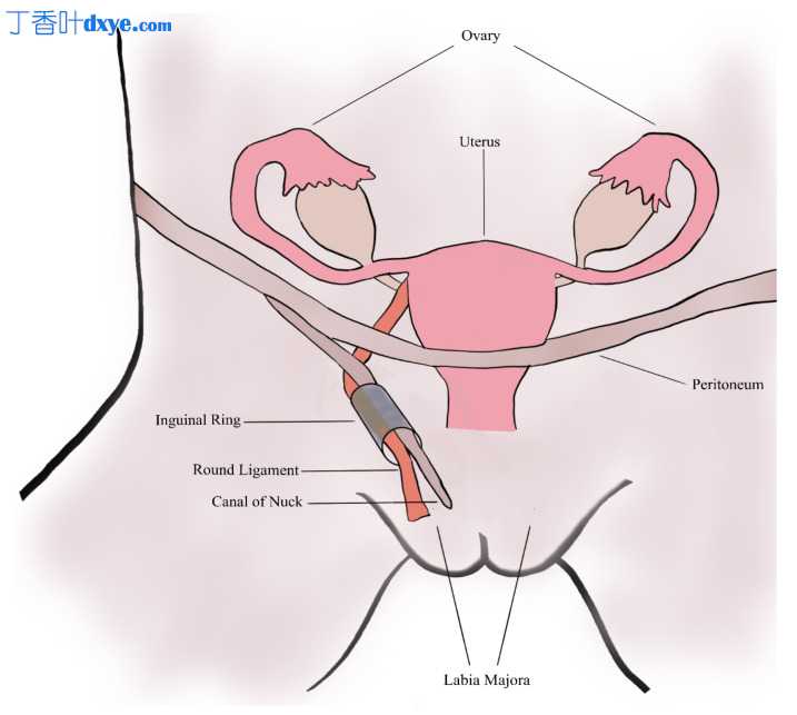 努克管囊肿：一个非常罕见的诊断的解剖学、诊断和治疗——一个成年女性的病例报告...