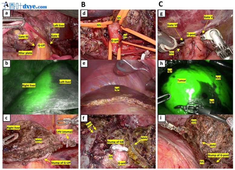 使用肝外 Glissonian 法对肝细胞癌进行微创解剖性肝切除术：手术技术和与开放入...