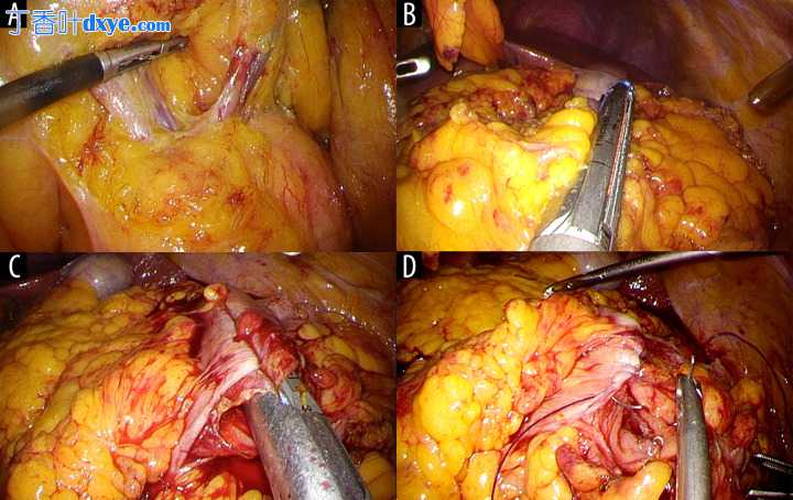 全反位患者腹腔镜结肠切除术：术前评估的有用性
