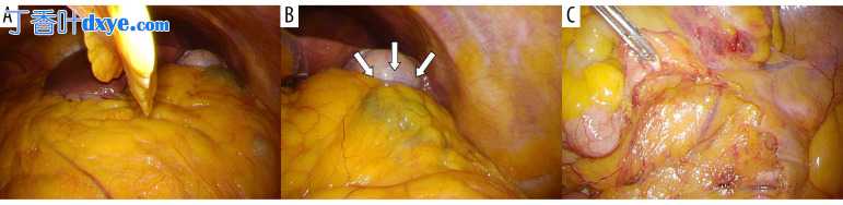 全反位患者腹腔镜结肠切除术：术前评估的有用性
