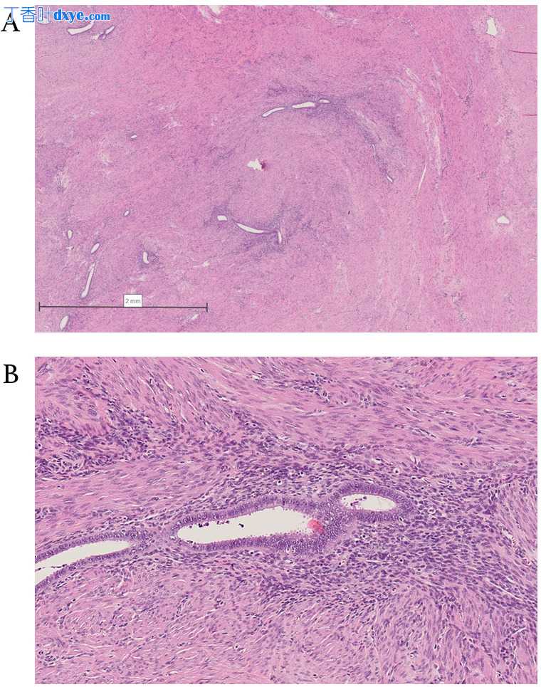 Mayer-Rokitansky-Küster-Hauser综合征盆腔实性肿瘤的腹腔镜介入治疗：双侧残基子...