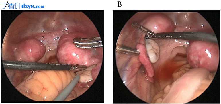 Mayer-Rokitansky-Küster-Hauser综合征盆腔实性肿瘤的腹腔镜介入治疗：双侧残基子...