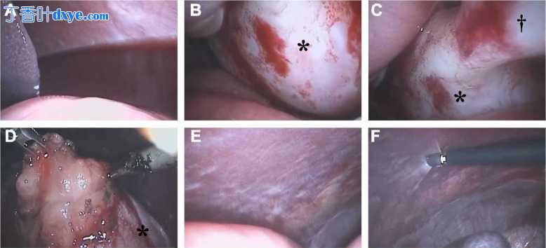 患有胰腺导管腺癌的狗的硬化性包膜性腹膜炎