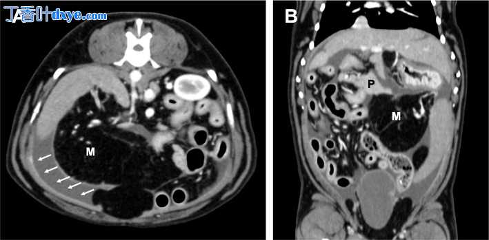 患有胰腺导管腺癌的狗的硬化性包膜性腹膜炎