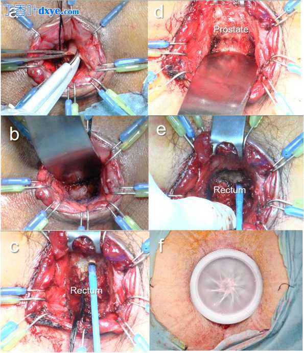 经肛门自下而上远端直肠解剖作为腹腔镜肛门附近直肠癌保留括约肌手术中实现全直肠...