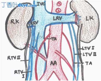 腹腔镜 TAPP 治疗右侧腹股沟外侧疝