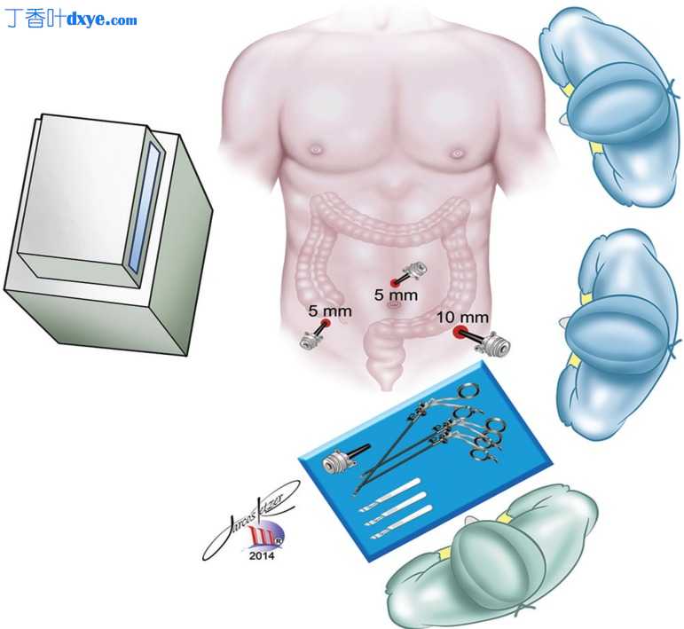 腹腔镜阑尾切除术步骤