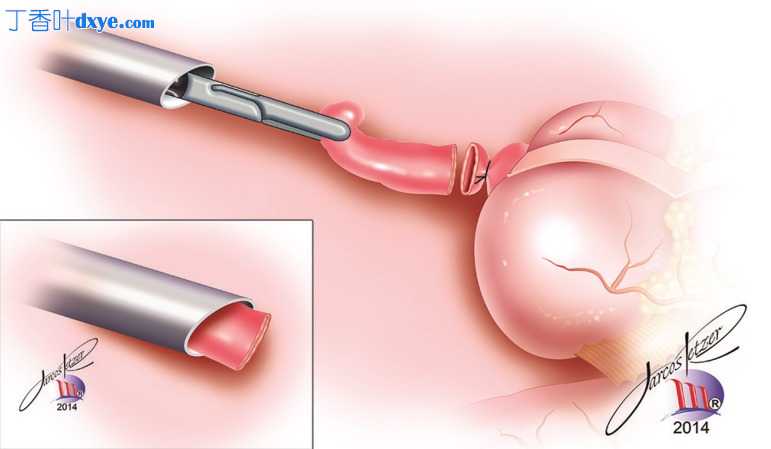 腹腔镜阑尾切除术步骤