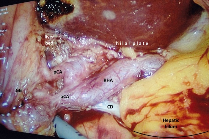 肝右动脉履带式驼峰——腹腔镜胆囊切除术