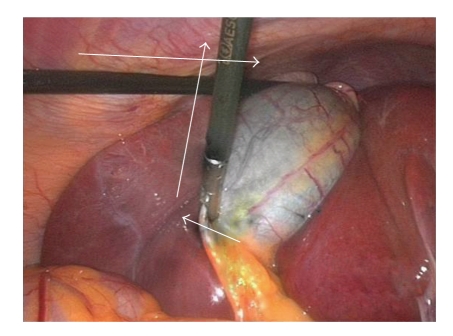 腹腔镜胆囊切除术治疗困难的Calots三角