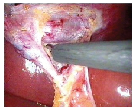 腹腔镜胆囊切除术治疗困难的Calots三角