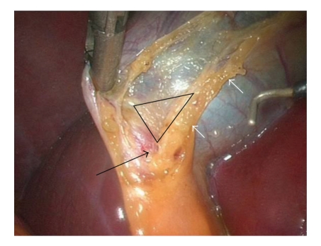 腹腔镜胆囊切除术治疗困难的Calots三角