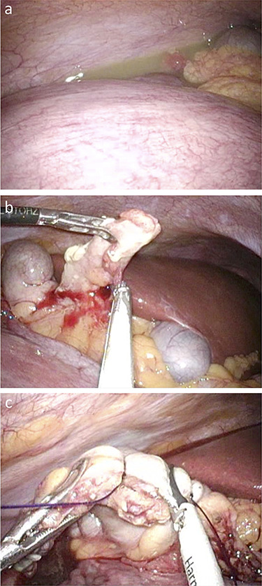 腹腔镜阑尾切除术