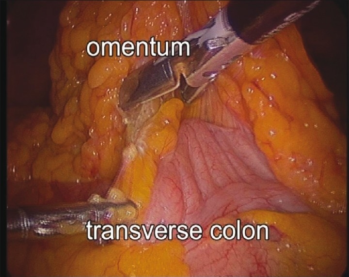 腹腔镜右半结肠切除术