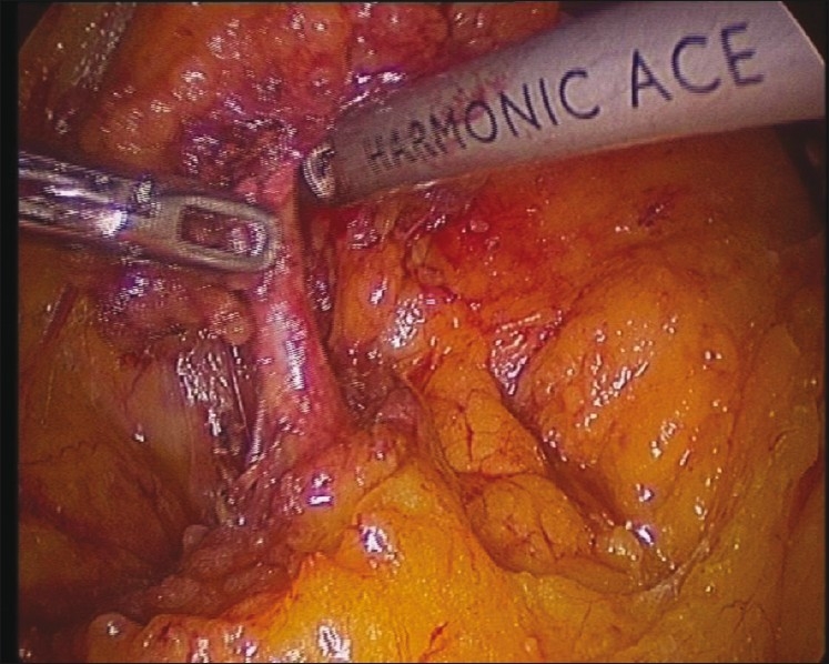 腹腔镜右半结肠切除术