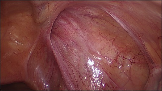 TAPP 腹腔镜腹股沟疝修补术使用胶水