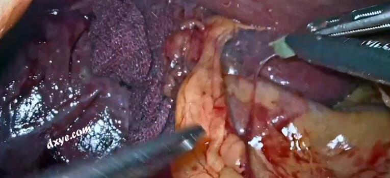 腹腔镜根治性胆囊切除术