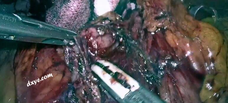 腹腔镜根治性胆囊切除术