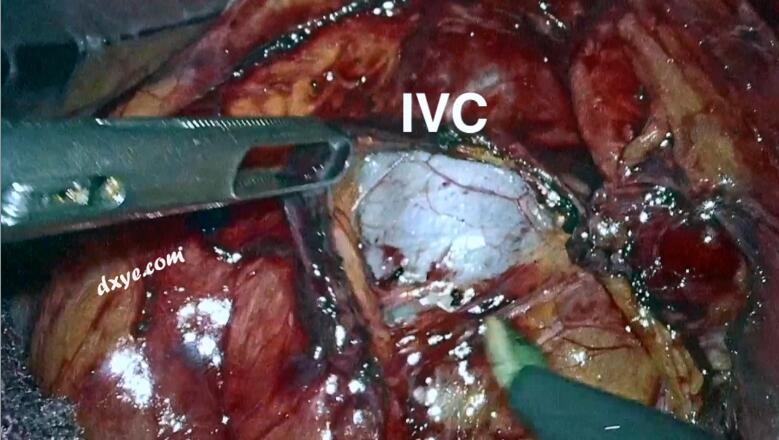 腹腔镜根治性胆囊切除术