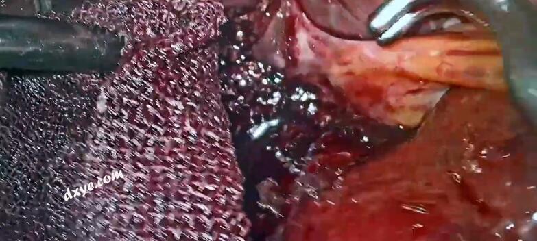 腹腔镜根治性胆囊切除术