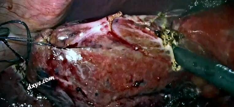 腹腔镜根治性胆囊切除术