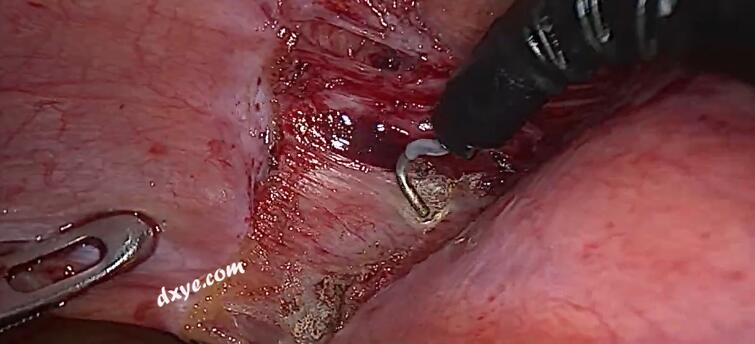 使用关节装置进行腹腔镜大型囊性盆腔肿块切除术