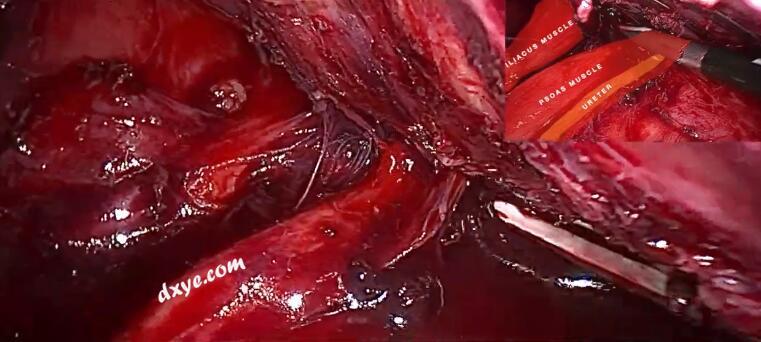使用关节装置进行腹腔镜大型囊性盆腔肿块切除术