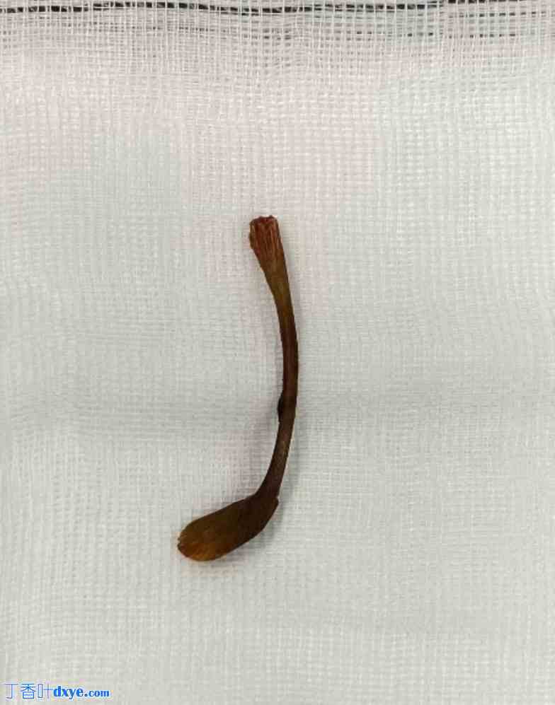 误食鸡叉骨致腹股沟阴囊疝囊内乙状结肠穿孔一例报告