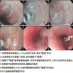 POEM治疗贲门失弛缓症