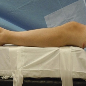 膝关节半伸直位胫骨髓内钉技术