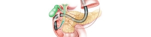 胆管狭窄是肝胆外科疾病进展与治疗过程中常见并发症。
