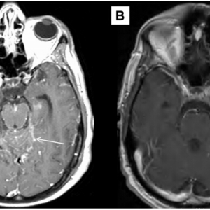 EGFR-19号外显子突变的NSCLC粟粒样转移1例