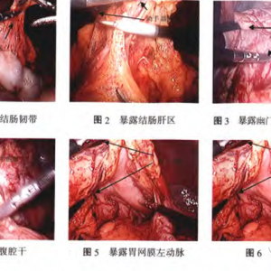 腹腔镜胃癌根治术团队中助手的配合与体会