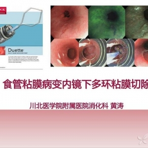 黄涛：食管粘膜病变内镜下多环粘膜切除